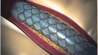 Angioplastia con Stent Parte 22  FOSCAL [upl. by Bikales]