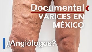 Varices en las Piernas Operación para Várices Mira este Video [upl. by Dalton]