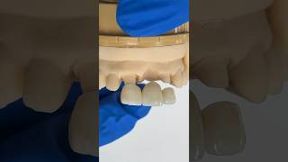 Monet Pure Zirconia Bridge EnvisiontecMain envisiontec lsk121shorts teeth dental [upl. by Aynotal646]