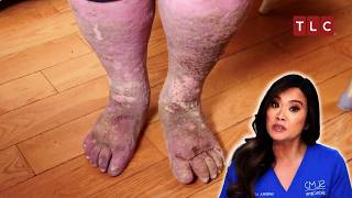 Sandra’s Fight Between Life and Death  Dr Pimple Popper  TLC [upl. by Lurleen]