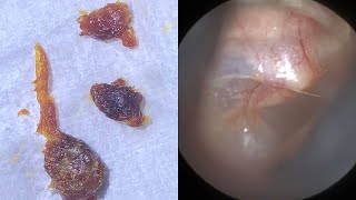 111  Narrow amp Bendy Ear Wax Removal with WAXscope®️ [upl. by Adlitam]