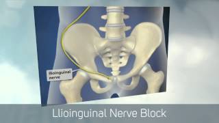 Dr Kornick Riverside Spine Jacksonville 904 3891010 Ilioinguinal Nerve Block [upl. by Enyawud]