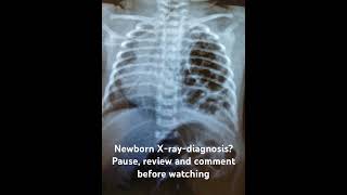 Newborn Xraydiagnosis Pause review and comment [upl. by Eeima]