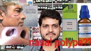 Nasal polypsHomeopathic medicine for nasal polyps explain [upl. by Nelad]