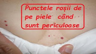 🍀Punctele roșii de pe piele – când sunt periculoase🔔 [upl. by Akenet688]