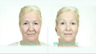 Dermawand International HD 2016 [upl. by Rozella]