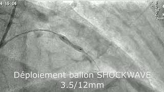 iva moy calcifiée shockwave [upl. by Aihsel]