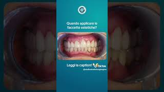 Prima e dopo  Faccette dentali [upl. by Rutra]