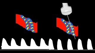 Umbilical Artery Doppler interpretation [upl. by Noremak429]