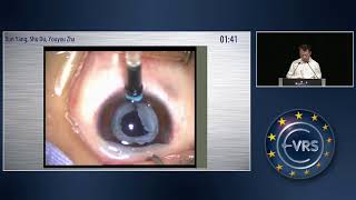 Increase Intraocular Pressure with Trabecular Meshwork Photocoagulation [upl. by Sine643]