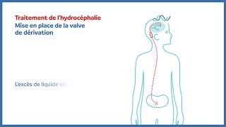 Hydrocéphalie  valve de dérivation peritonéale [upl. by Rosenstein]