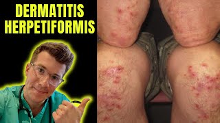 Dermatitis Herpetiformis rash seen in Coeliac Disease aka gluten intolerance explained [upl. by Htebzil]