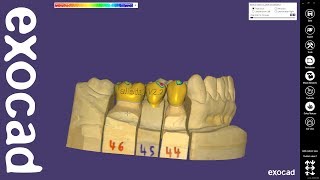 exocad Quick Guide New features in DentalCAD 22 Valletta [upl. by Laekcim]