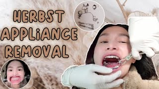 REMOVAL of MY HERBST APPLIANCE  BRACES ADJUSTMENT  19Months [upl. by Troth]