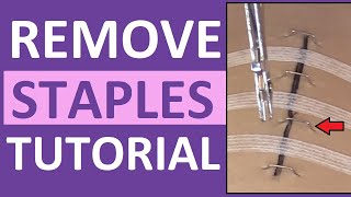 Surgical Staple Removal Nursing  How to Remove Surgical Staples [upl. by Perni691]