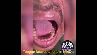 TONGUE FASCICULATIONS [upl. by Ahsiena]