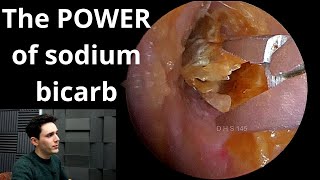 Sodium Bicarbonate Drops VS Earwax amp Dead Skin [upl. by Darach599]