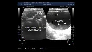 Mesenteric Lymphadenitis and UTI in a child aged two and half years [upl. by Fauman]