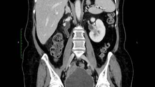 pyelitis CT [upl. by Athiste]