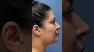 Natural Buccal Fat Removal [upl. by Valenza]