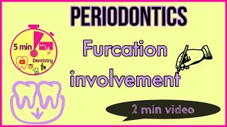 FURCATION INVOLVEMENT  Glickmans classification in 2 minutes  Periodontics [upl. by Sherourd]