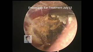 Completely blocked ear cleaning 20230715 [upl. by Cynde]