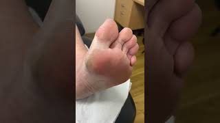 Ditch the discomfort Watch an Aussie podiatrists big toe callus removal wizardry [upl. by Hummel]