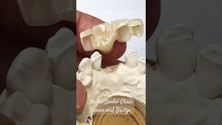 Veneer and Bridge👍😃 indradentalvlogs veneers dentist shorts drrahultripathi [upl. by Ha]