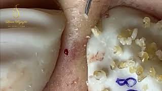 Loan Nguyen Acne Treatment 408pre [upl. by Everard]