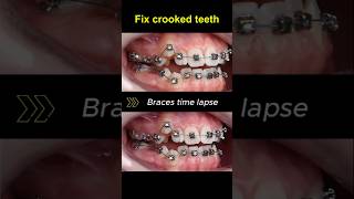 Braces for crooked teeth transformation before and after braces orthodontist dentist bracket [upl. by Mackler]