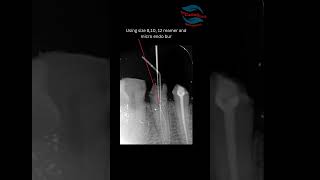 Management of mandibular premolar with middle third bifurcation [upl. by Gruver516]