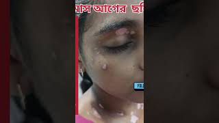 Vitiligo treatment safeed daag ka ilajBefore After result Just 1 monthhair regrowth 9734984030 [upl. by Alegnaoj]