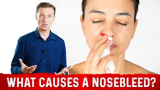 What Causes NosebleedsEpistaxis – 8 Common Causes of Nose Bleeding – DrBerg [upl. by Solberg]