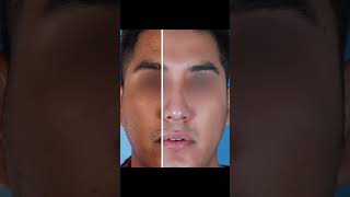 Rhinoplasty Before amp After by a Nose Surgeon [upl. by Ahsiel876]