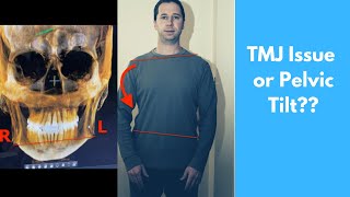 The Truth about Lateral Pelvic Tilt [upl. by Jacquelynn319]