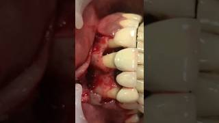 Gingival Flap Surgery [upl. by Francie]