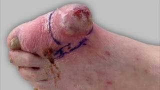 Draining pus from a foot infection [upl. by Elleirbag]