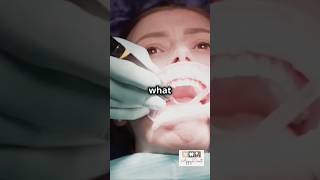 What is dental scaling How scaling is done Why scaling is done dentalscaling dentalinfluencer [upl. by Taryne258]