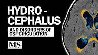 Hydrocephalus And the Disorders of CSF Circulation [upl. by Etirugram]