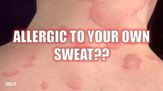 Are You Allergic To Your Own Sweat Here’s why… [upl. by Iey]