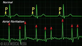 Atrial Fibrillation Anatomy ECG and Stroke Animation [upl. by Shay]