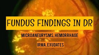 DIABETIC RETINOPATHY clinical findings  Microaneurysms hemorrhage irma hardexudates and more [upl. by Aikmat592]