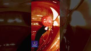 Colon Polyp Removal  3D Animation [upl. by Ledba]