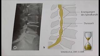 Bandscheibenvorfall und Wirbelsäulenerkrankungen [upl. by Anauqcaj]