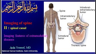 7 spinal canal  extramedullary lesions [upl. by Eima]