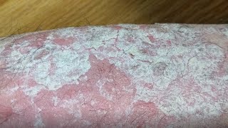 EXTREME REGENERATION REPTILE LEGS Psoriasis [upl. by Ignacius]