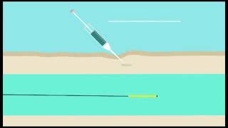 Déroulement dune ablation thermique endoveineuse [upl. by Eilama365]