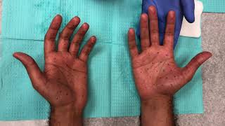 Botox palm injections for hand sweating hyperhidrosis [upl. by Psyche]