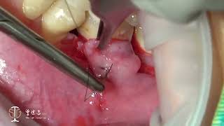 Modified Lateral Pedicle Flap for Augmentation of Keratinized Gingiva at Mandibular Molar IV [upl. by Aryn589]