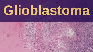 What is a Glioblastoma  Pathology mini tutorial [upl. by Aken610]